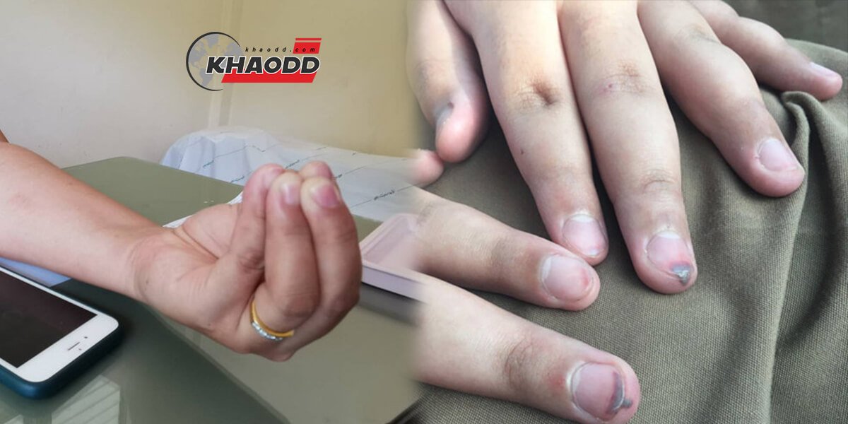 ทำโทษหนัก !! ครูทำโทษนักเรียน ป.6 สั่งเด็กทำมือจีบ ใช้แปรงลบกระดาษตีจนนิ้วมือห้อเลือด