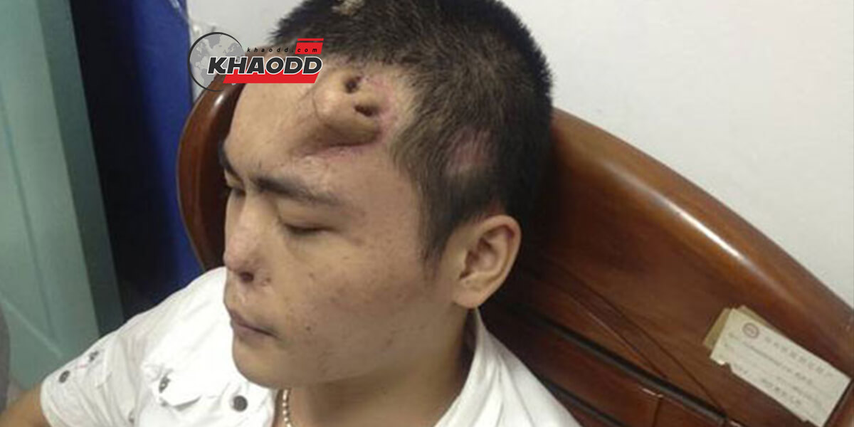 แพทย์จีนปลูกจมูกคนไข้บนหน้าผาก รอแปะกลับที่เดิมเร็วนี้ เรื่องราวสุดแสนประหลาด 
