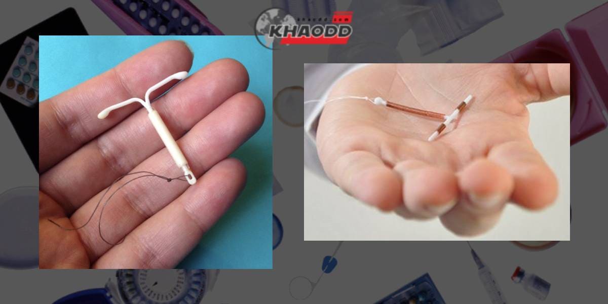 แบ่งออกได้เป็น 2 ประเภท : Copper IUDs (Paragard) และ IUDs เกี่ยวกับฮอร์โมน (Mirena, Kyleena, Liletta และ Skyla)