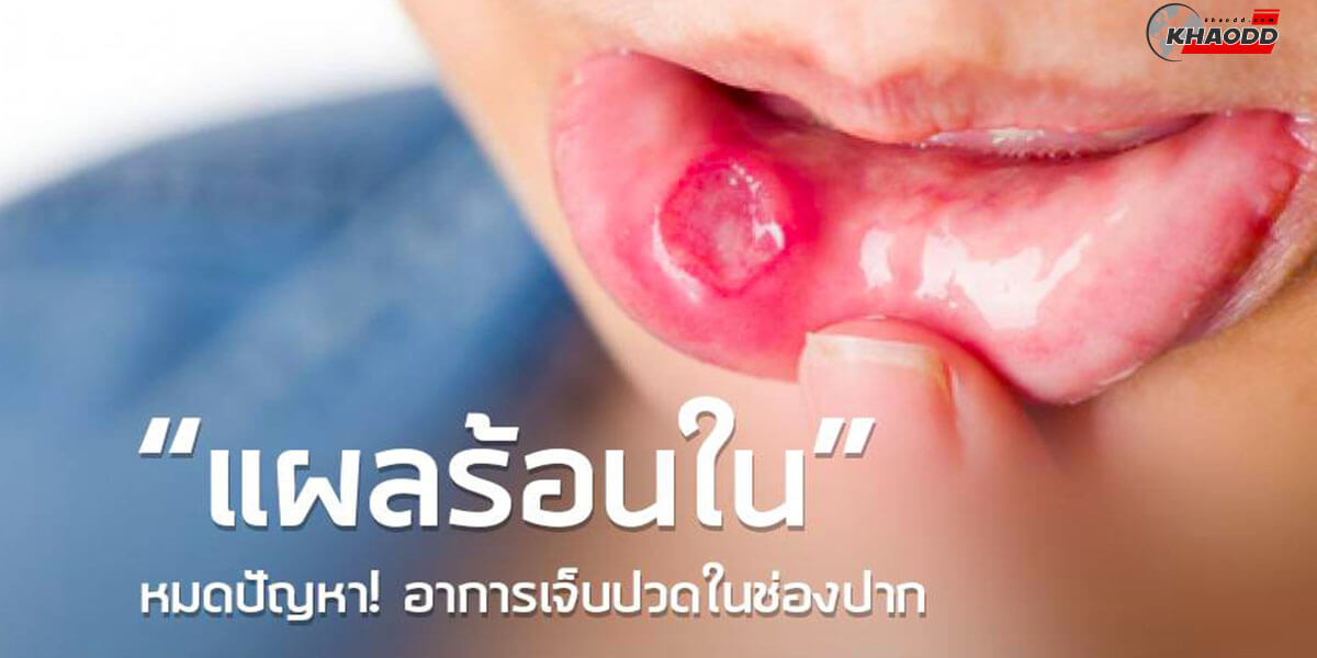 วิธีรักษาแผลร้อนใน-ด้วยทางลัด