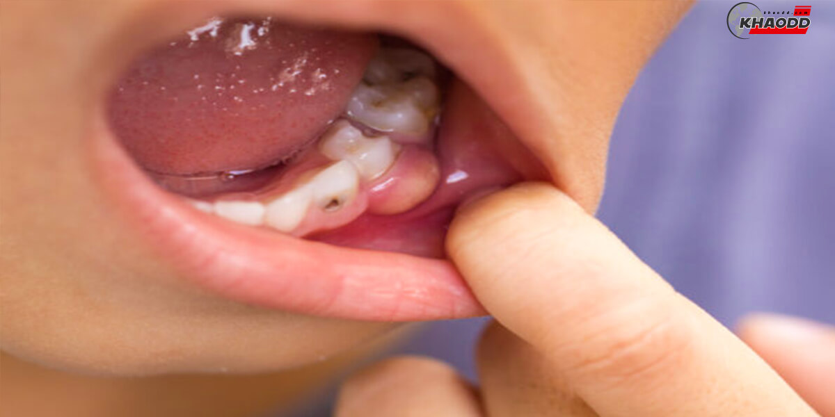 วิธีเช็คสุขภาพเหงือก-สุขภาพช่องปาก