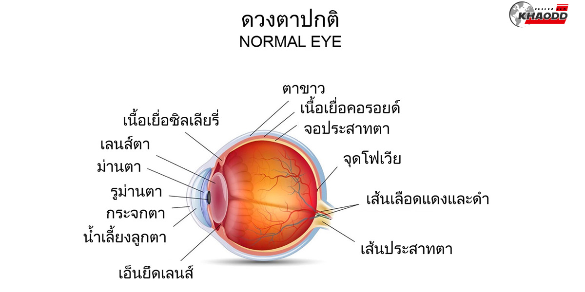 เสี่ยงเบาหวานขึ้นจอตา-ภาวะแทรกซ้อน