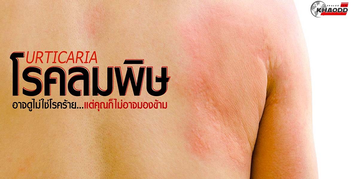 โรคลมพิษคืออะไร-Urticaria, Hives