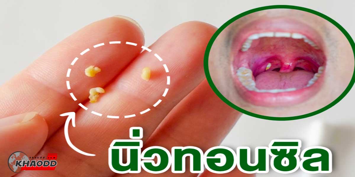 Tonsillar Concretion