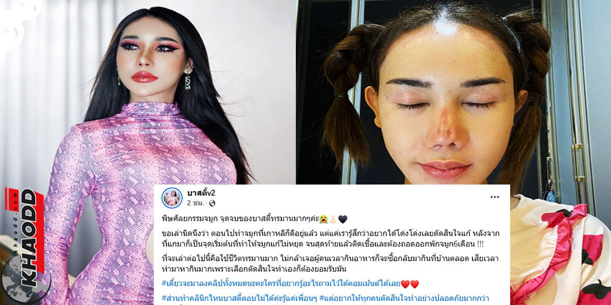 ข่าวเด่นออนไลน์ พิษศัลยกรรม "บาสตี้" หน้าสวยกลายเป็นหน้าผี พักจมูกยาว 6 เดือน