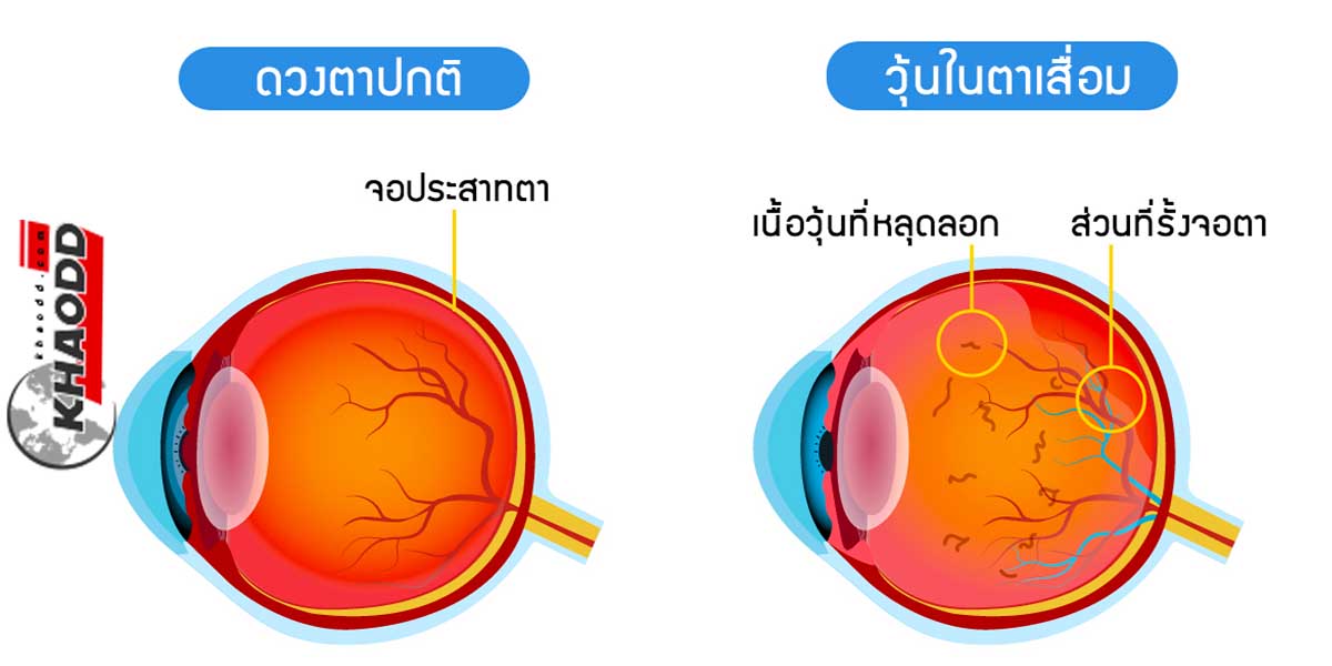 Eye Floaters หากปล่อยทิ้งเอาไว้นานอาจเป็นอันตรายต่อดวงตา