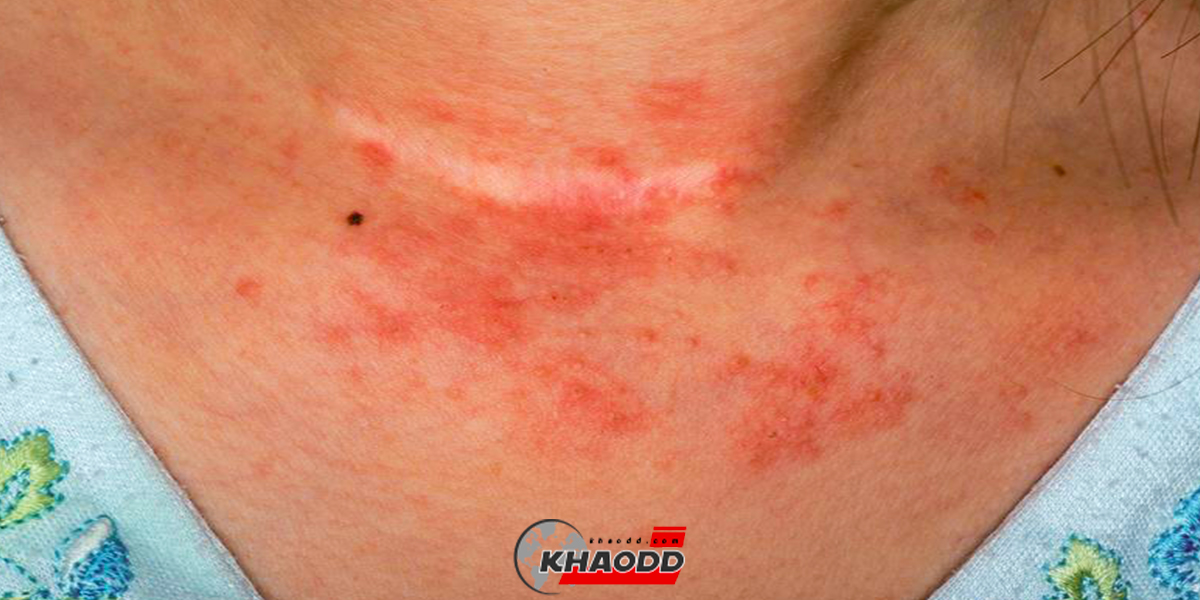 โรคผิวหนังอักเสบจากภูมิแพ้ (Atopic eczema) 