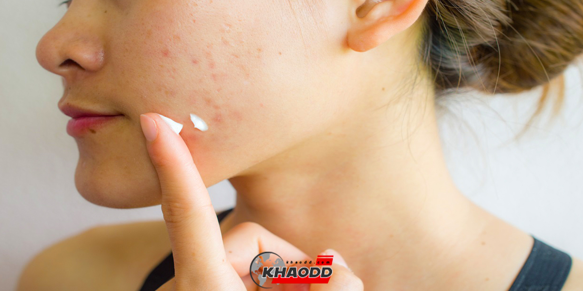 สิวเห่อ (Seasonal aggravation of acne) 