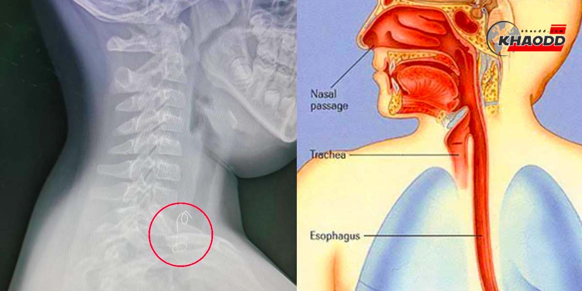 หมอเอกซเรย์พบ “ลวดยาว” 8 ซม. อยู่ในคอ