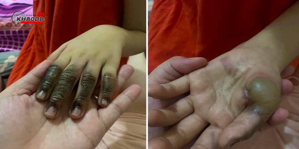 หนูน้อยวัย 7 ขวบ มือมีแผลและมือไหม้เพราะเสียบปลั๊กไฟเอง