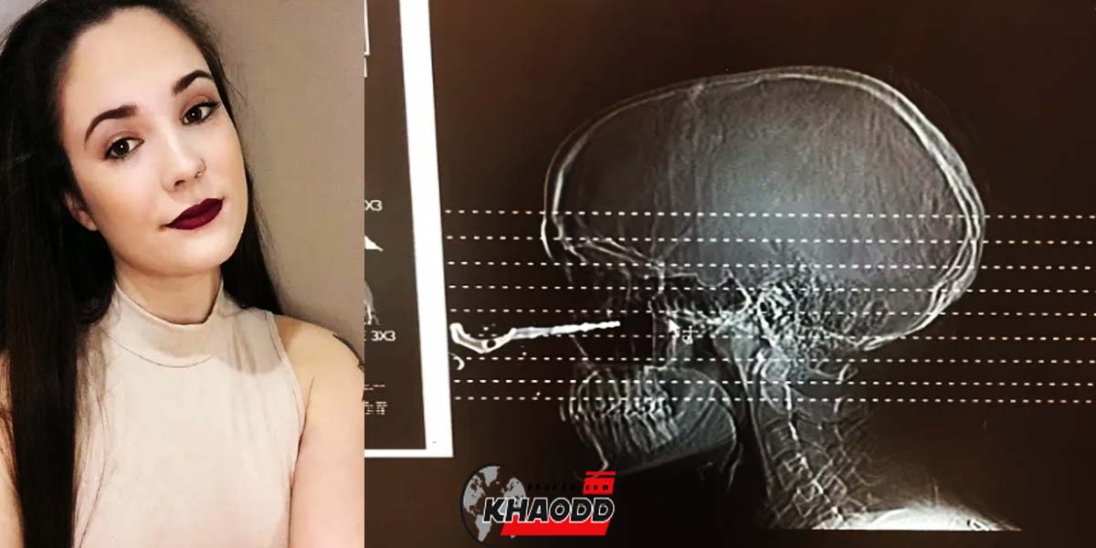 ข่าวต่างประเทศ ภาพเอกซเรย์ Renée Lariviere หญิงสาววัย 24 ปี อุบัติเหตุ กุญแจปักแก้ม