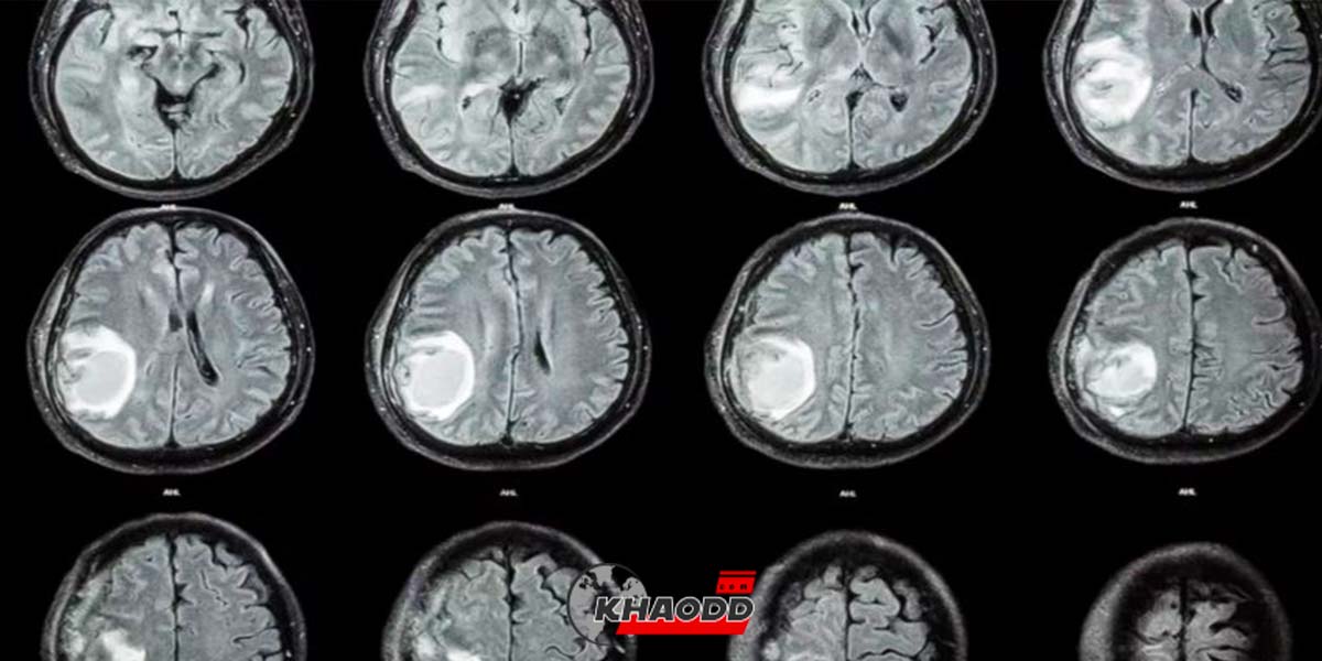 ผ่าตัดแฝดปรสิตในสมอง-ออกจาก “ศีรษะทารก”