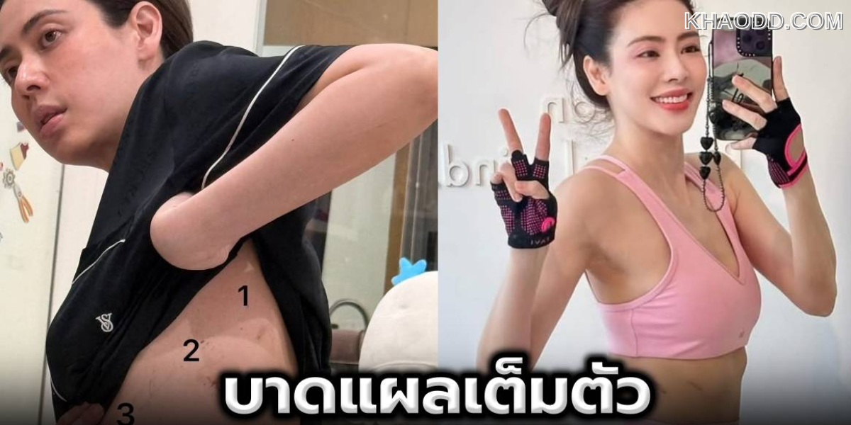 รอยแผลทั้งตัว _ป๋อ_ อโหสิกรรมถูกด่าแรง