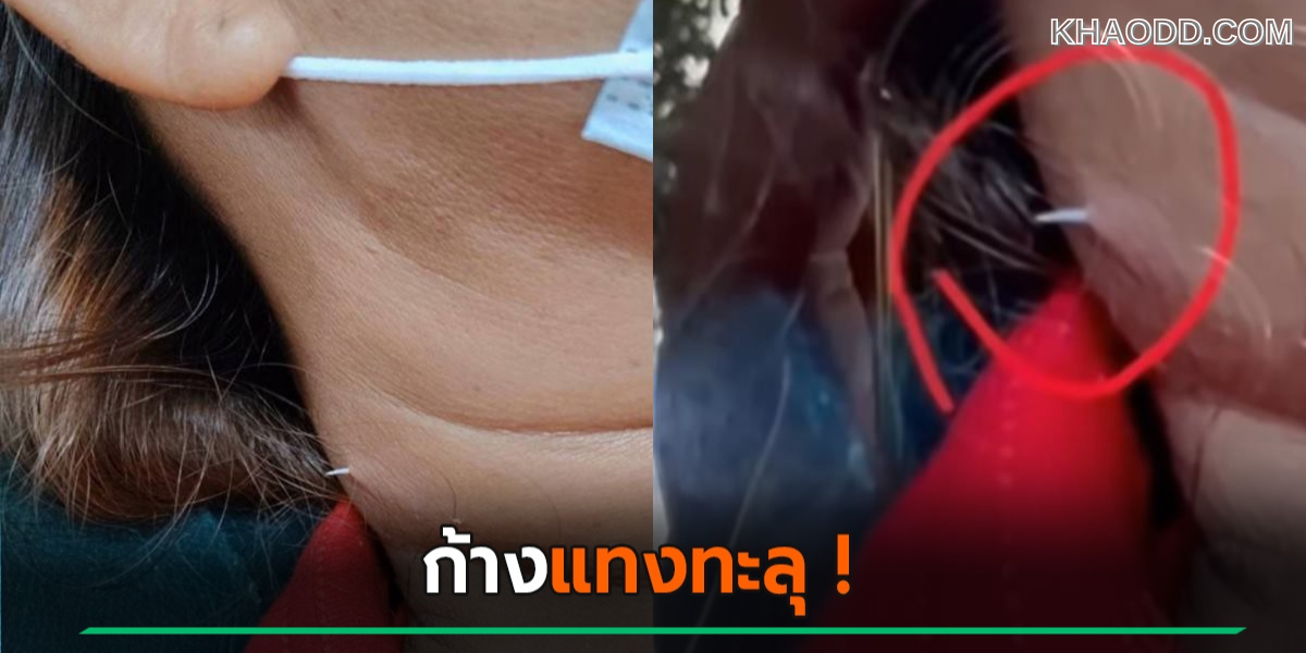 อุทาหรณ์! สาวใหญ่กินปลาแล้ว “ก้างติดคอ”