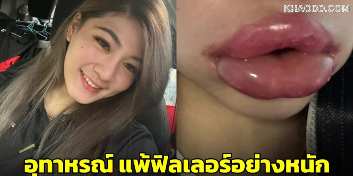 ไปฉีดฟิลเลอร์เเต่ตัวเองเกิดเเพ้ (2)