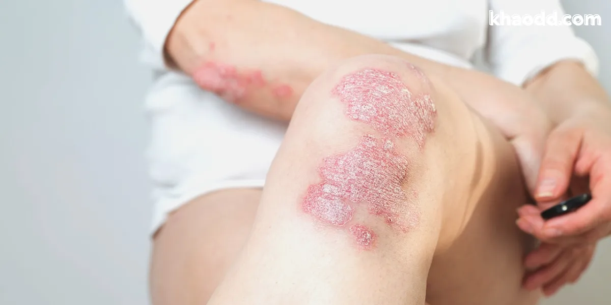 โรคพุ่มพวง (SLE) โรคแพ้ภูมิตัวเอง อาการ สาเหตุ และการรักษาที่ควรรู้