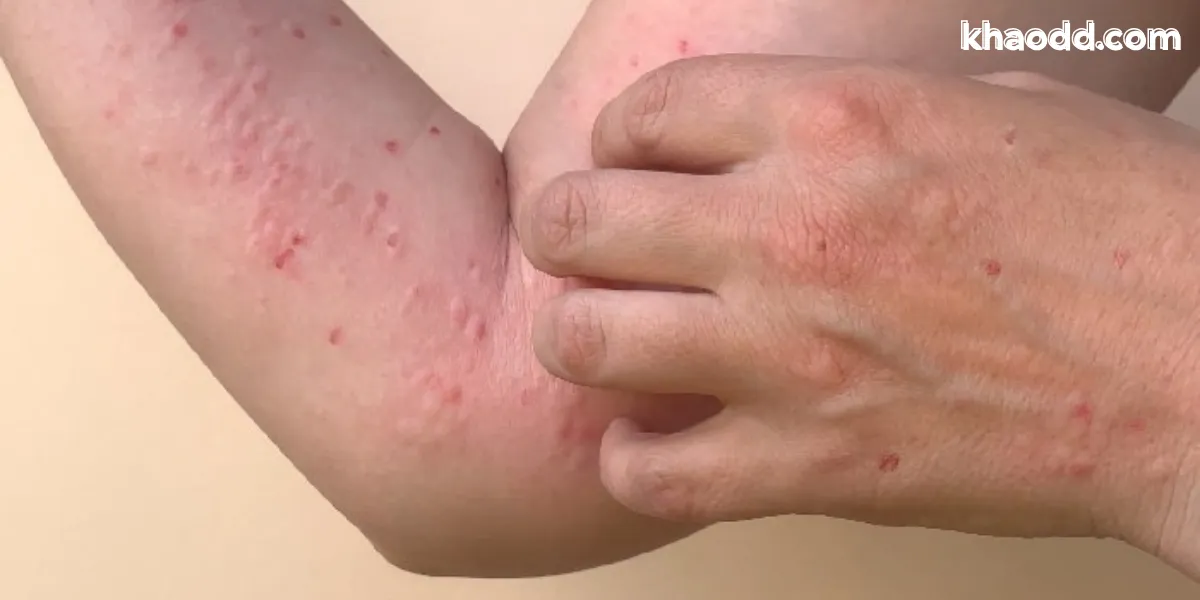 โรคพุ่มพวง (SLE) โรคแพ้ภูมิตัวเอง อาการ สาเหตุ และการรักษาที่ควรรู้