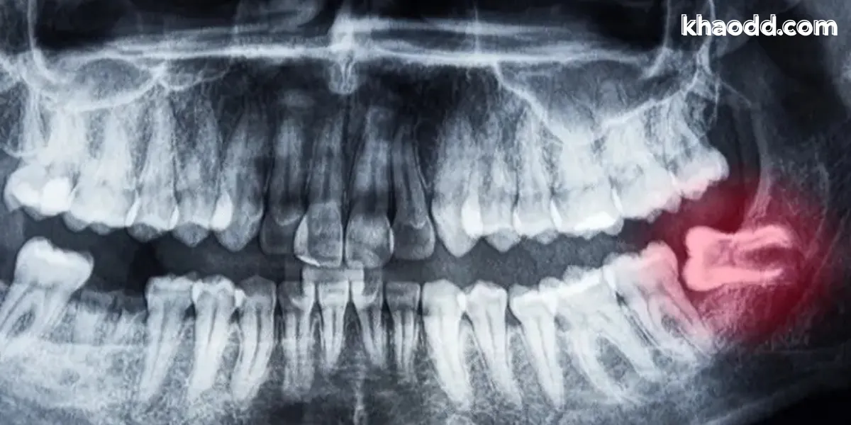 ผ่าฟันคุด