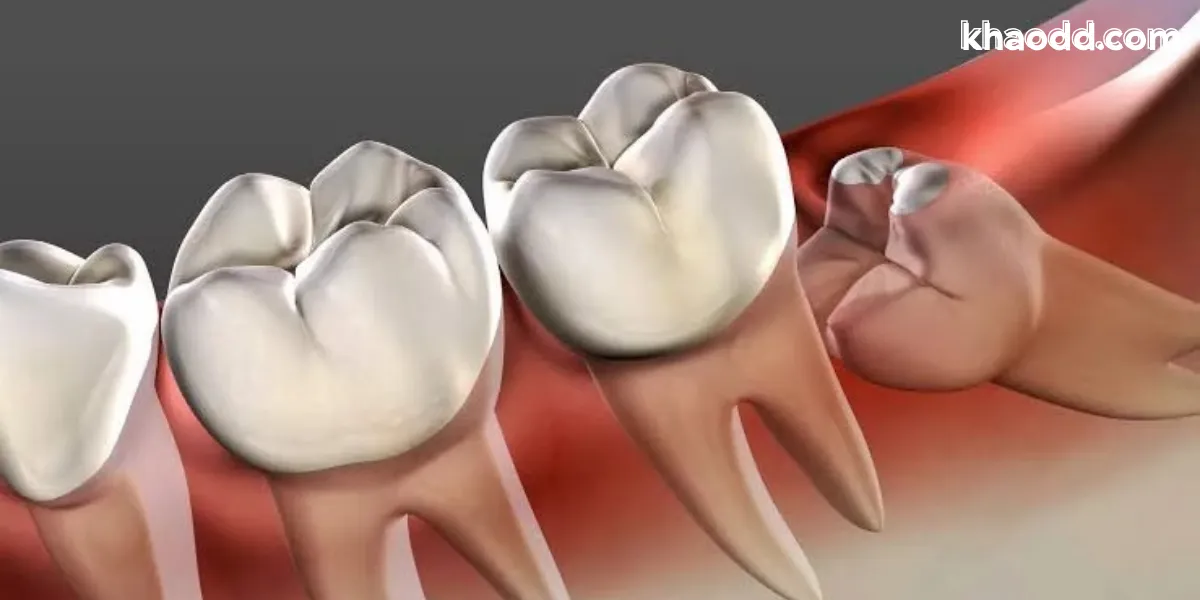 ถึงเวลาต้องผ่าฟันคุด