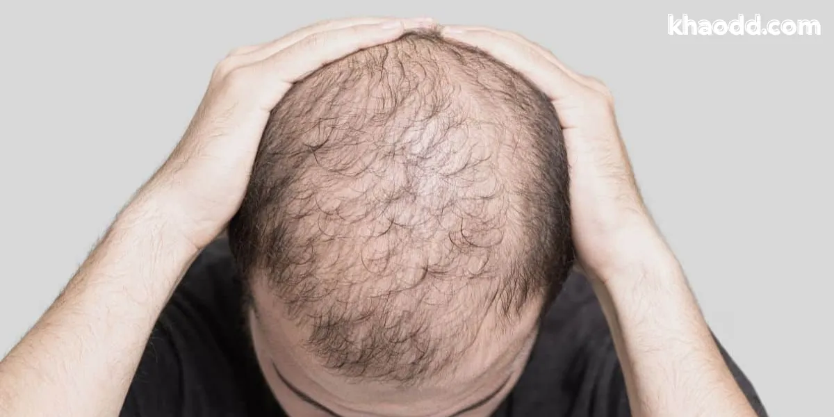 ความหมายโดยรวมของการฝันว่าหัวล้าน