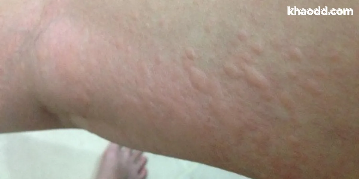 สาเหตุของลมพิษหน้าหนาว เกิดจากอะไรได้บ้าง