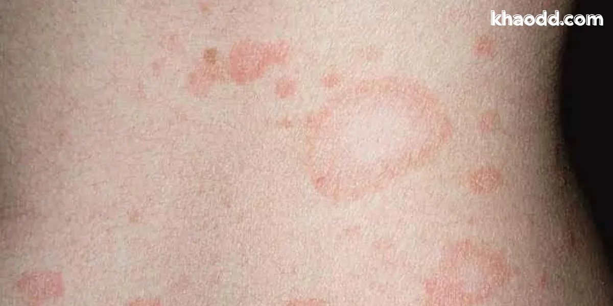 ผื่นกุหลาบคืออะไร