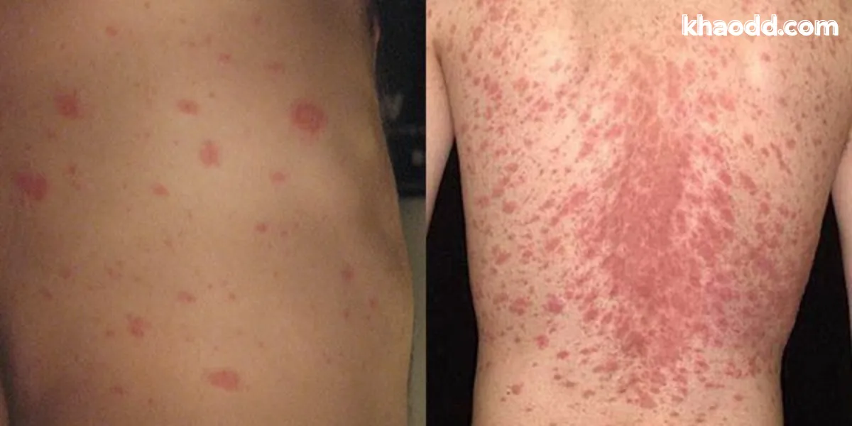 ผื่นกุหลาบ คืออะไร อาการ สาเหตุ และวิธีดูแลรักษาให้หายไว