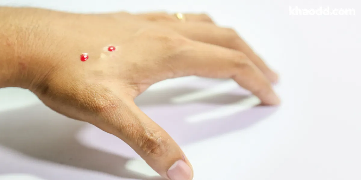 ฝันว่างูกัด หมายความว่าอะไร ทำนายฝันตามความเชื่อ แนวโน้มโชคลาภ