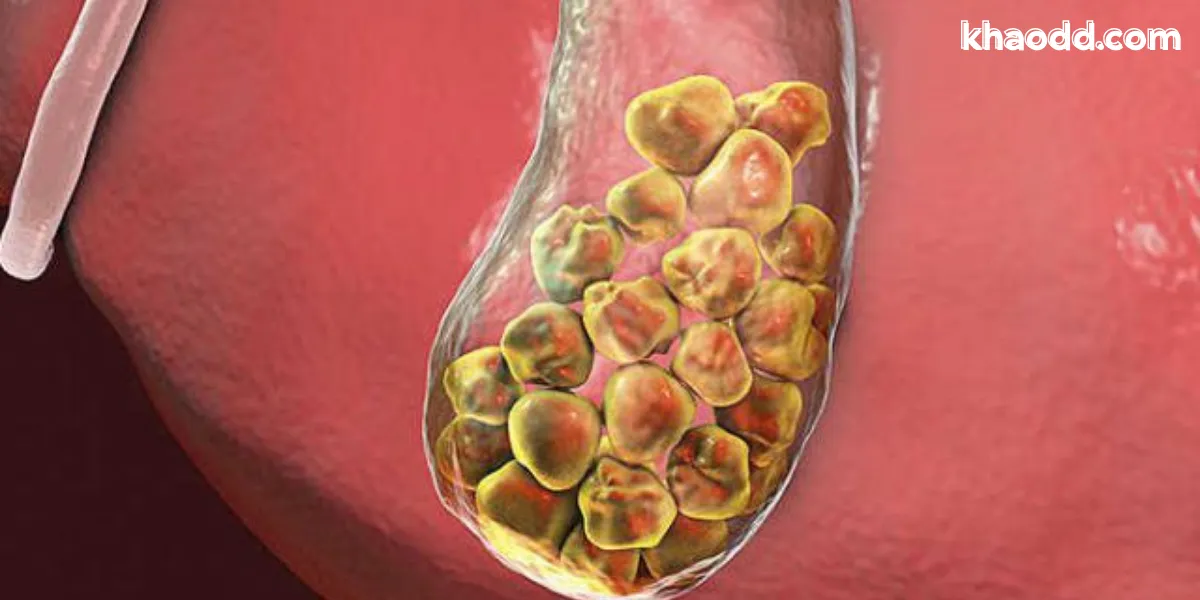 นิ่วในถุงน้ำดี