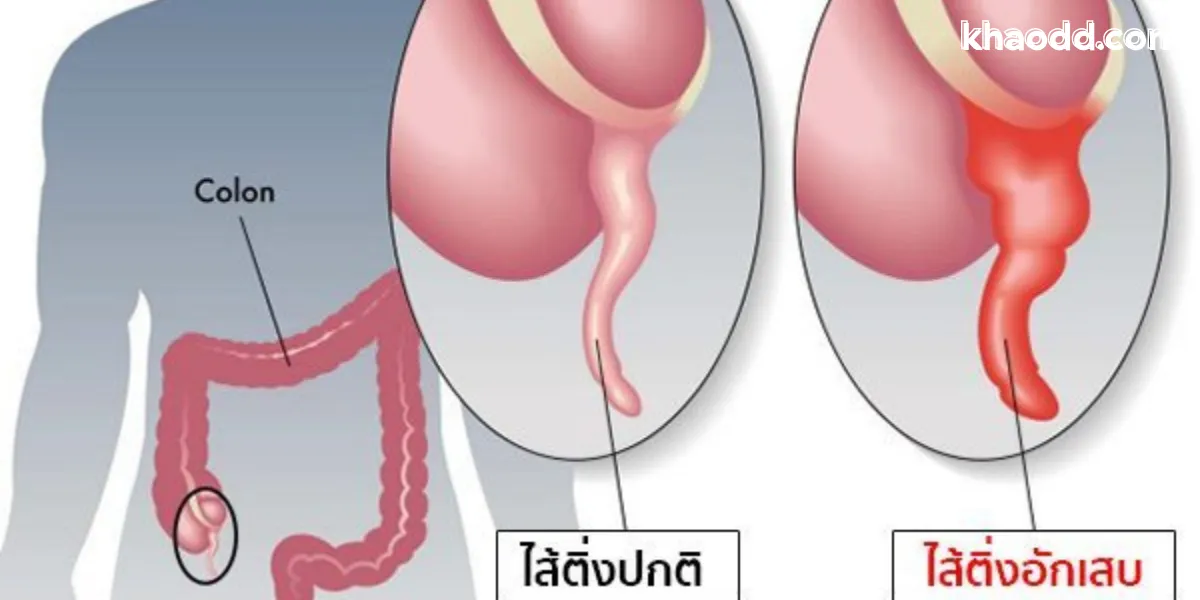ไส้ติ่งอักเสบ